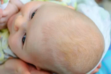 Seborea u novorozenců. Praktické rady a tipy pro rodiče!